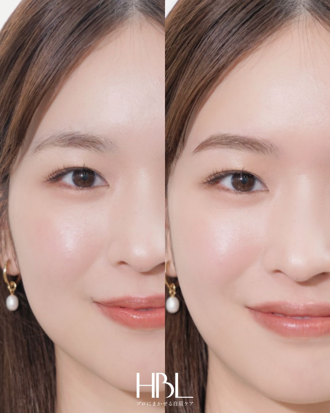 HBL(ハリウッドブロウリフト)の施術例