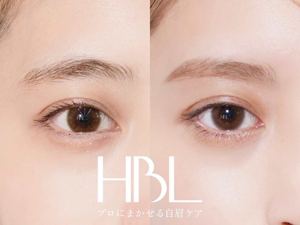 HBL（ハリウッドブロウリフト）の施術例