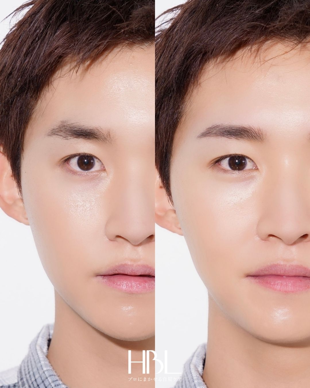 HBL（ハリウッドブロウリフト）の施術例