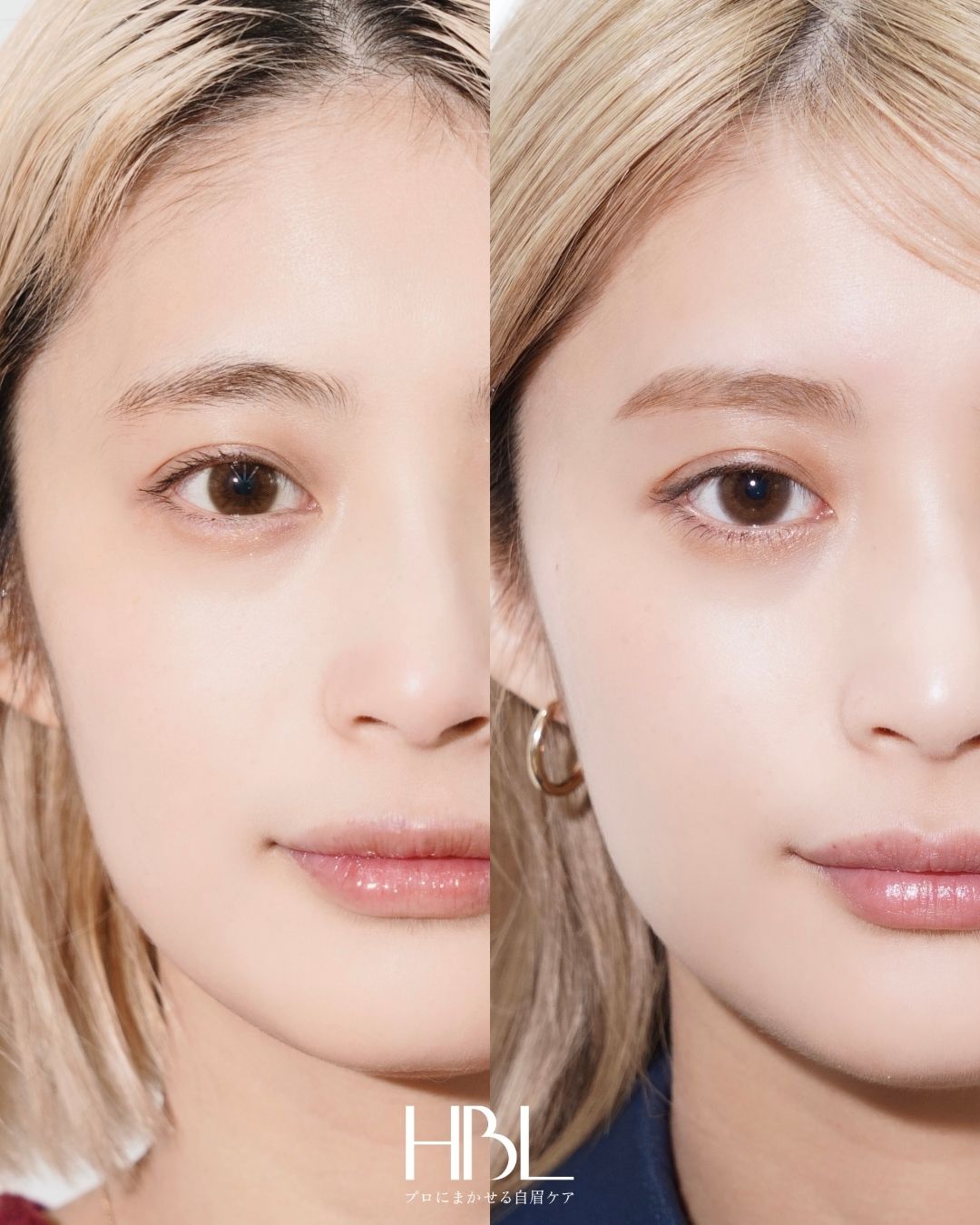 HBL（ハリウッドブロウリフト）の施術例