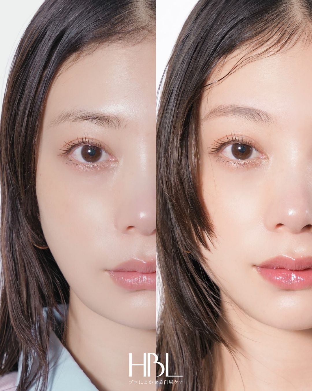 HBL（ハリウッドブロウリフト）の施術例